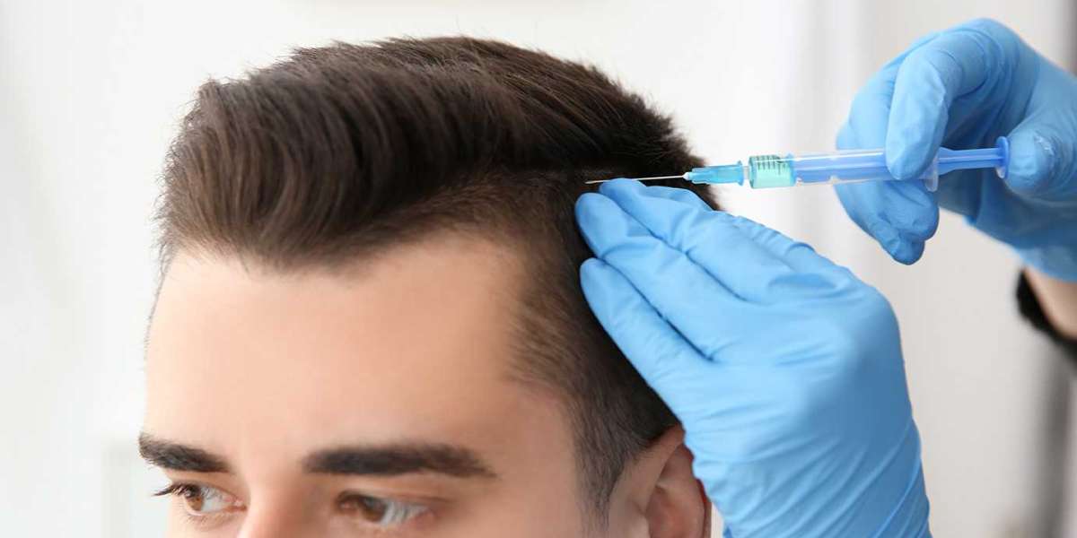 PRP Hair Restoration Procedure: A Promising Method Of Hair Regrowth