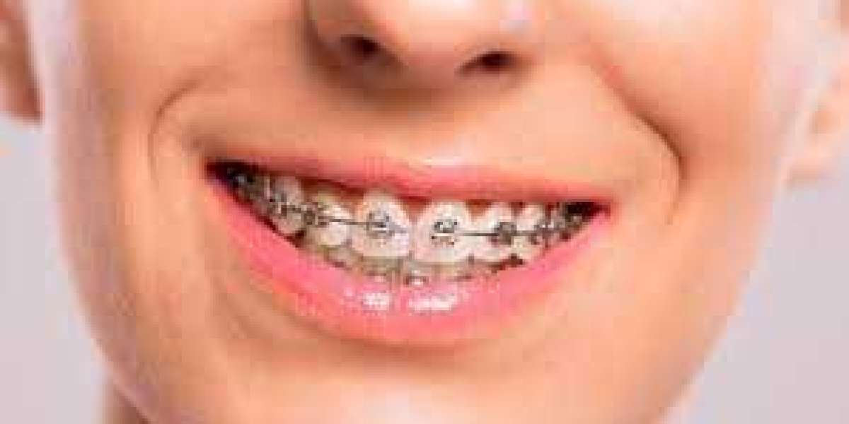 Tips for Affording Braces Without Insurance