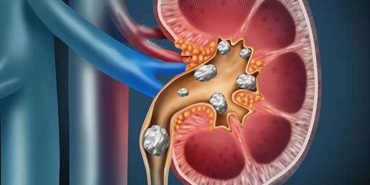 Kidney Stone Prevention and Treatment in Bangalore: Your Guide to a Healthier Life