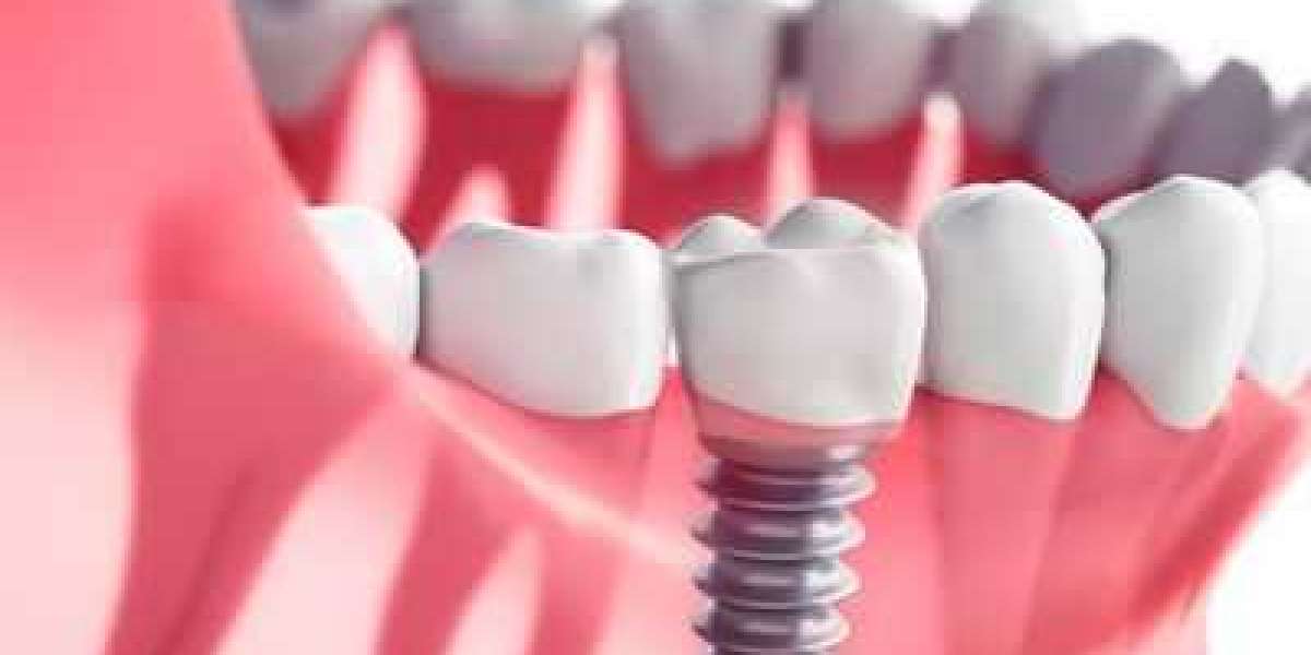 What do dental implants cost in coimbatore?