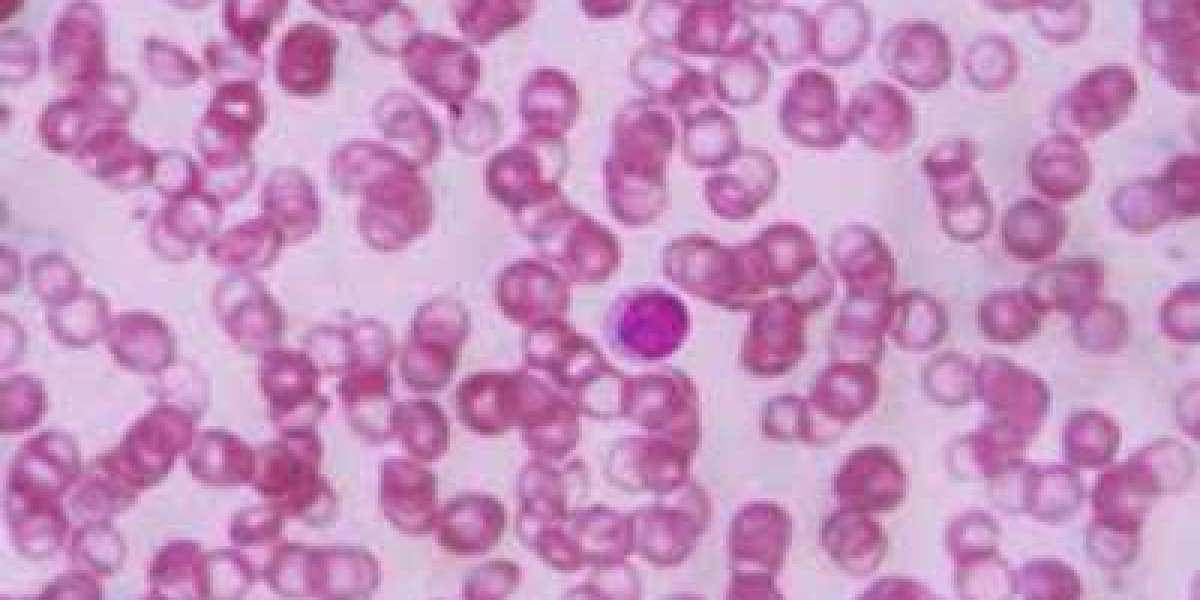 Sickle Cell Disease Diagnosis Market Size to Surge $7.9 Billion By 2030
