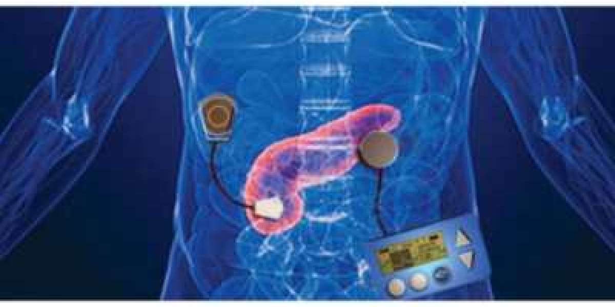 Artificial Pancreas Device System Market to Hit $285.40 Million By 2030