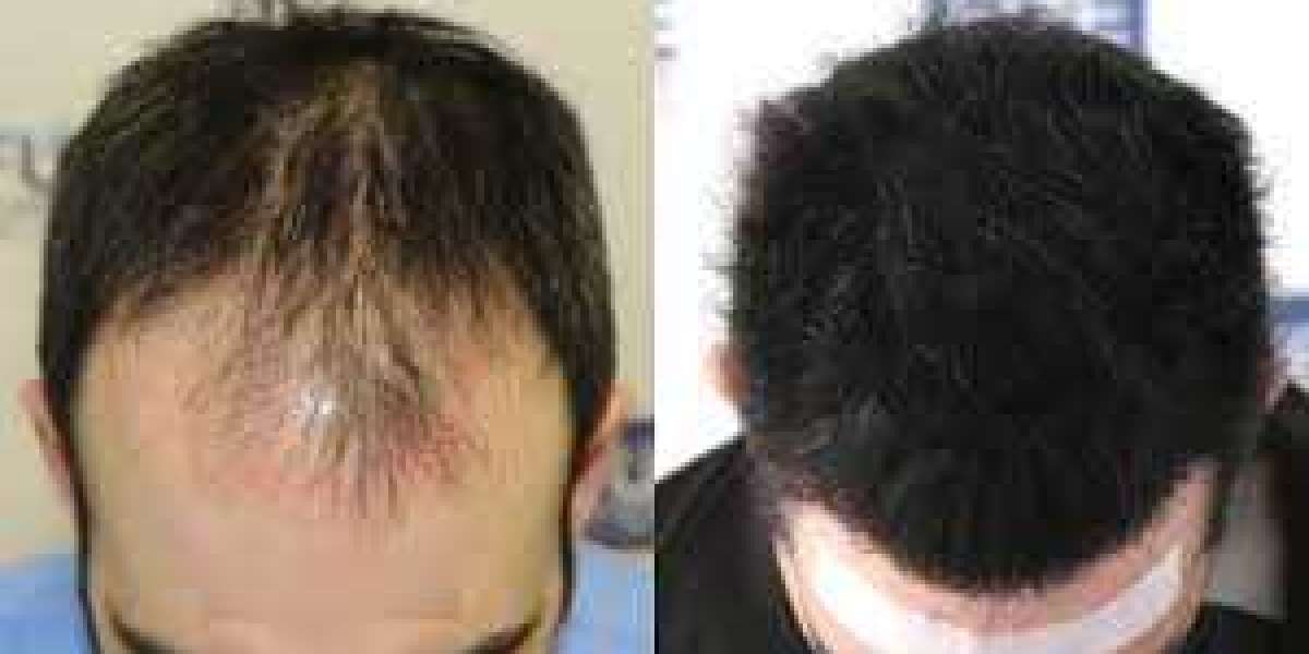 Repairing a Poor FUE Surgery With FUT