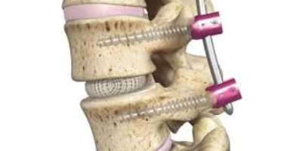 Spinal Interbody Fusion Market Size to Surge $9.22 Billion By 2030