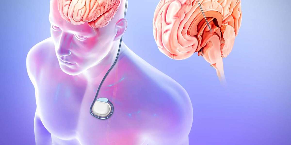 The Global Epilepsy Surgery Market Share to Witness Many Developments during 2023 -2030; MRFR