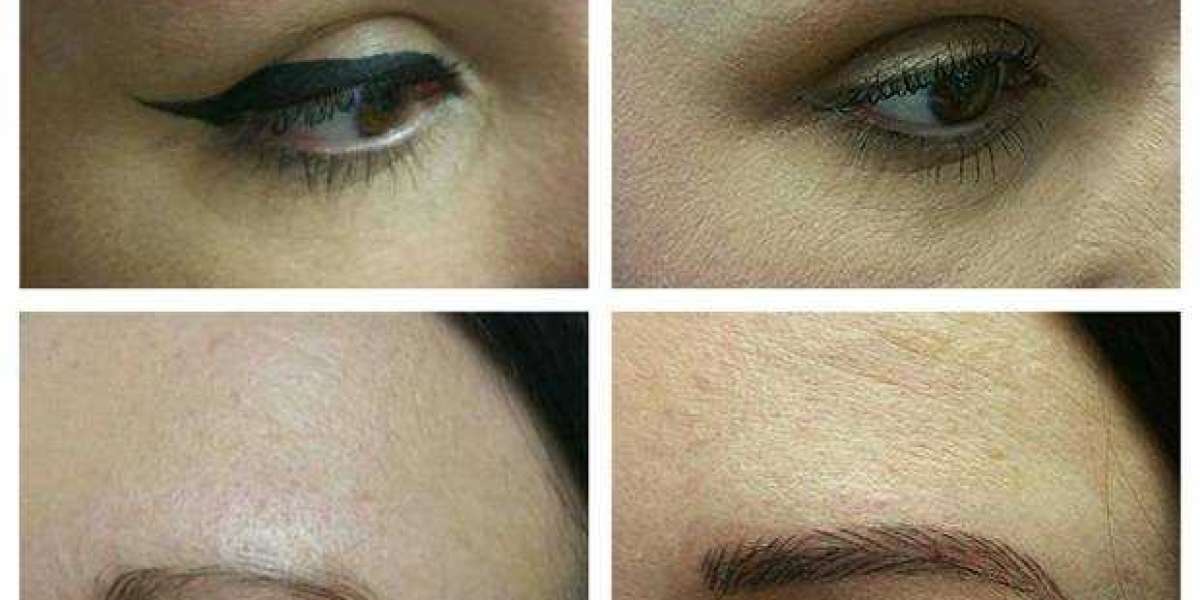 What is The Eyebrow Restoration Procedure?