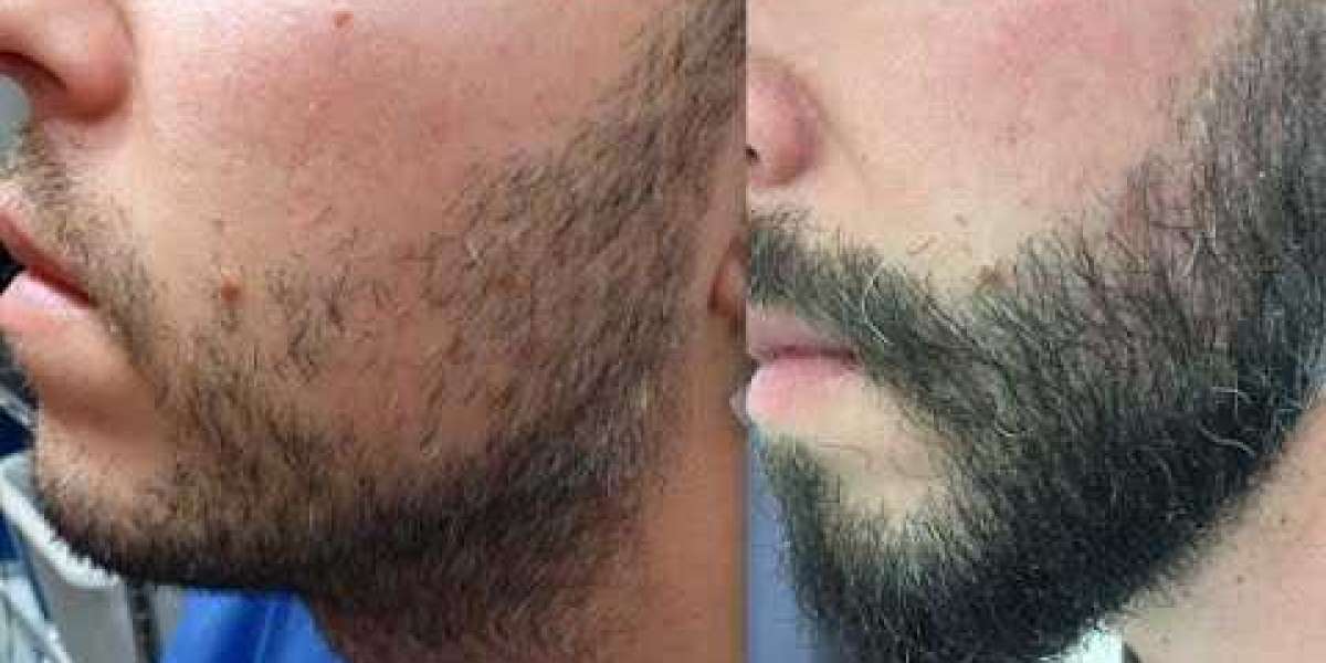 How Beard Hair Transplant Performed?