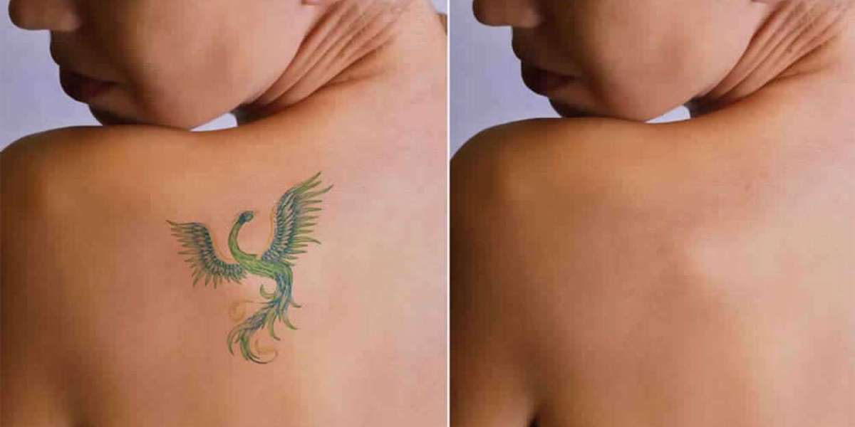 Tattoo Removal Market Size, Share, Growth, Trends 2024-2032