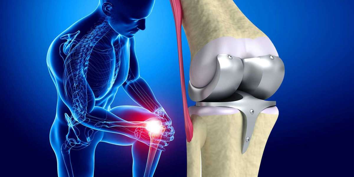 Research report on Global Knee Replacement Market Share with Industry Size & Future Growth