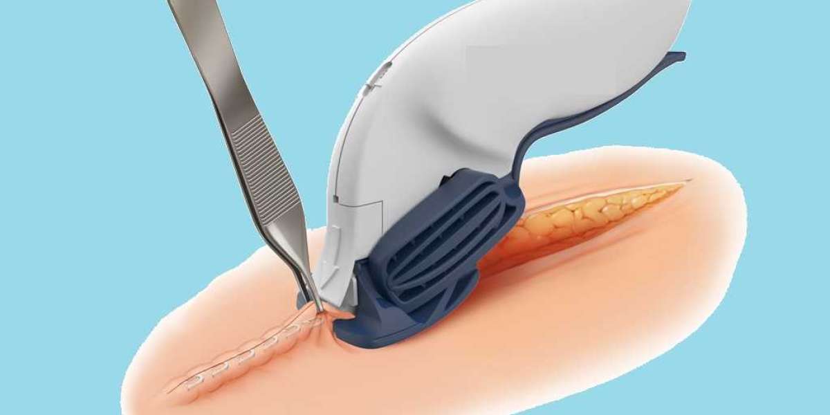 Surgical Staplers Market Share of Top Key Players with Tactics for Industry Growth