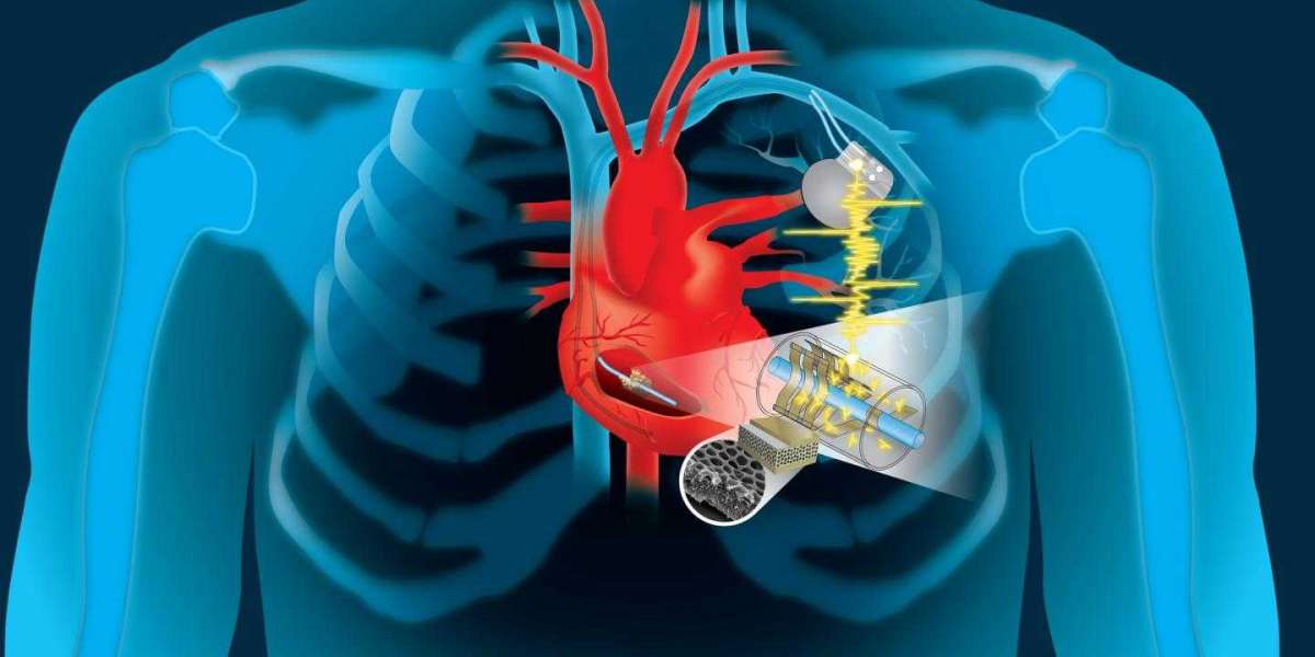 Global Cardiac Implants Market Share Emergence 2022-2030, Insights on Industry Size & Growth