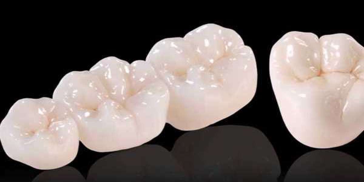 Choosing the Right Dental Clinic for Dental Crowns in St. Catharines