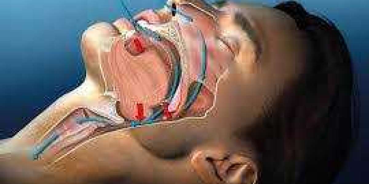 Anti-snoring Devices And Snoring Surgery Market Soars $2.1 Billion by 2030