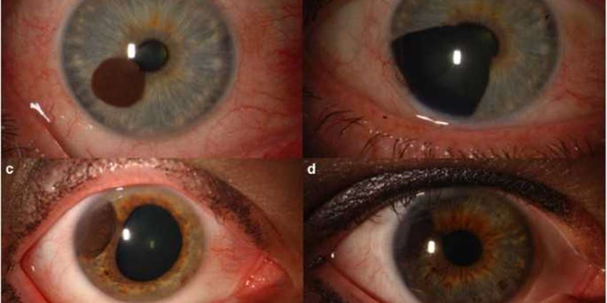 Uveal Melanoma Market Report (2023-2033): Epidemiology, Industry Trends, Share, Size, Demand