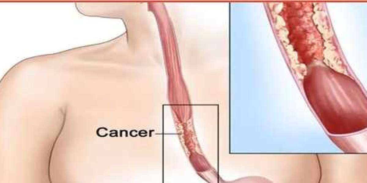 Esophageal Cancer Treatment in India