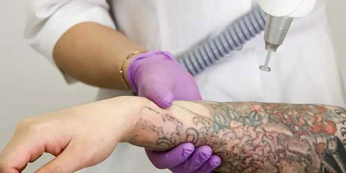Tattoo Removal In Delhi