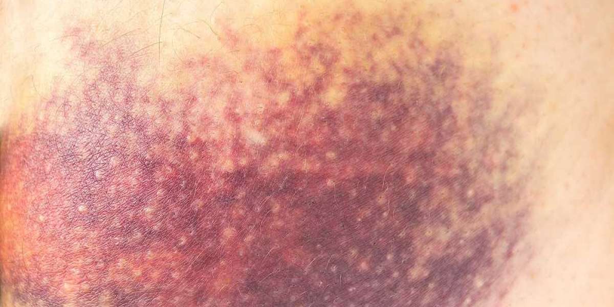 Calciphylaxis Market Report: Epidemiology, Trends and Forecast to (2023-2033)