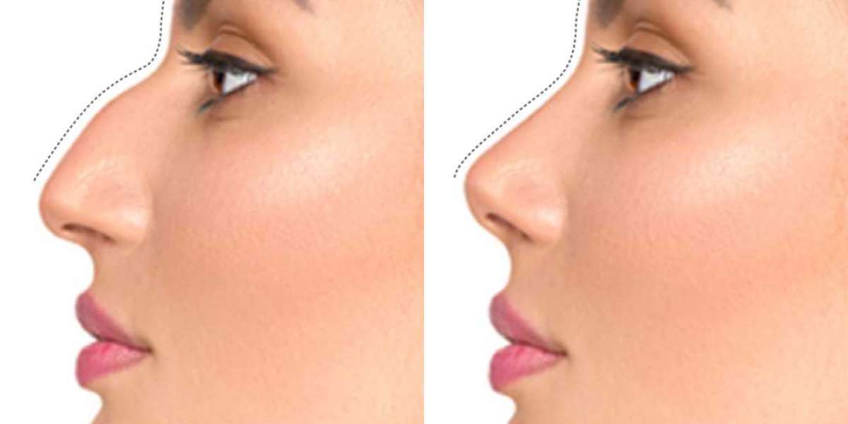 How Long Does It Take to Heal After Rhinoplasty
