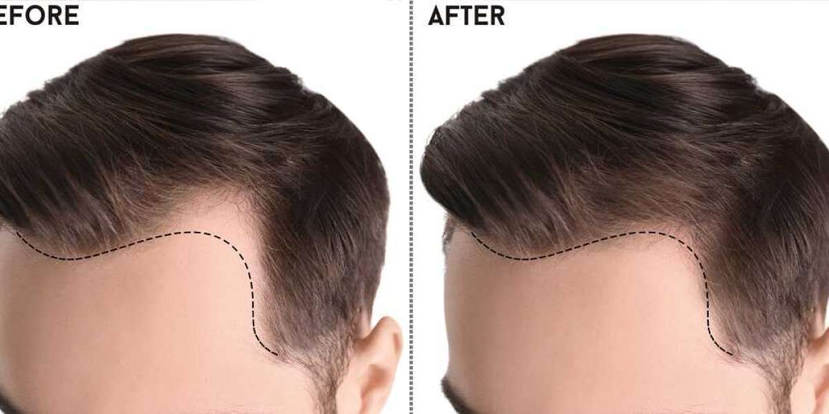 Decoding Excellence: Your Ultimate Guide to Finding the Best Hair Transplant in Pakistan