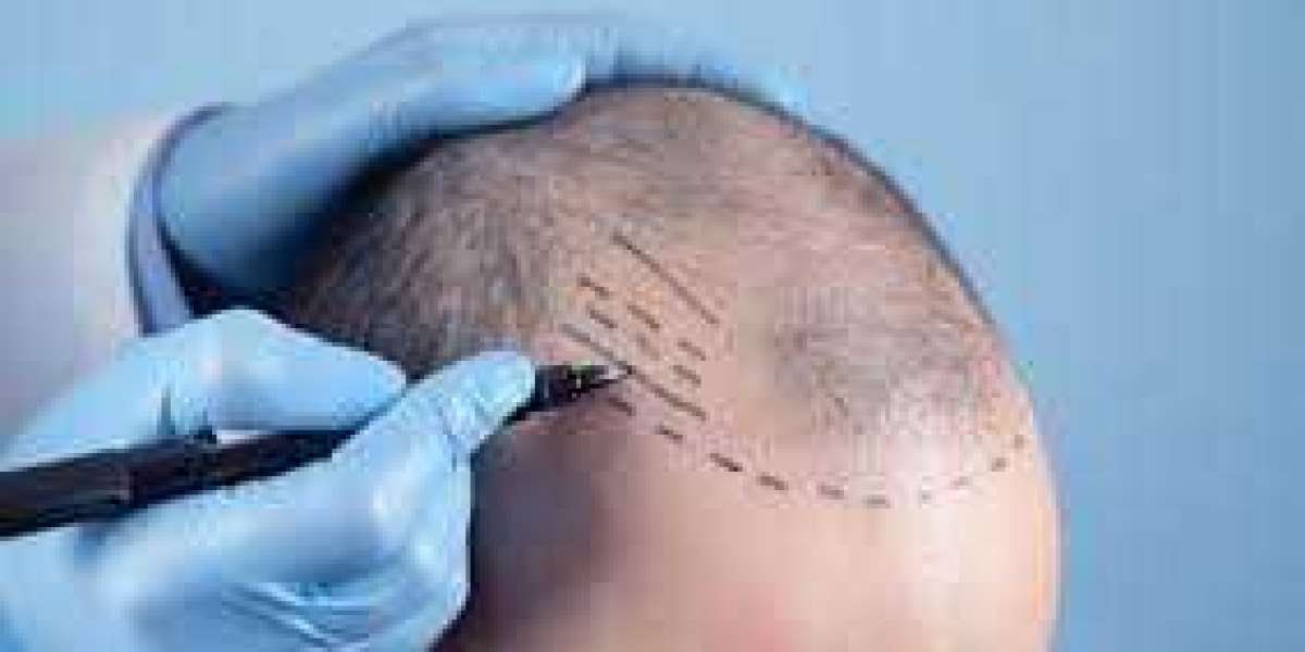 What is Microblend Grafting in Hair Transplant?