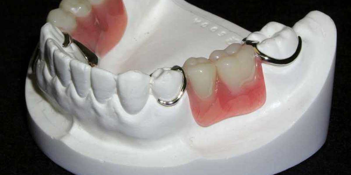 Removable Partial Denture Market size is expected to grow USD 1,715.4 million by 2033
