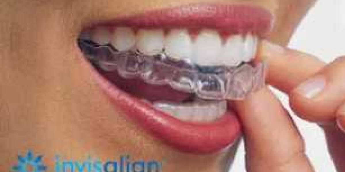 Unlocking Your Perfect Smile: Exploring the Wonders of Invisalign Treatment