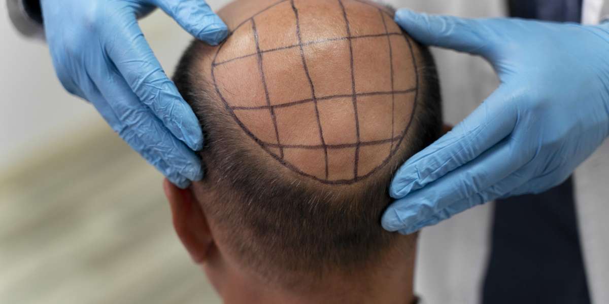 Hair transplant is not considered an effective treatment for alopecia areata?