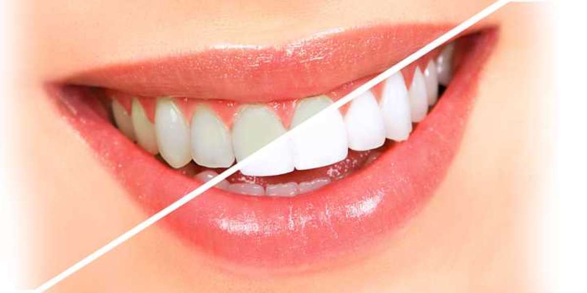 Teeth Whitening for Special Occasions: Planning Your Perfect Smile