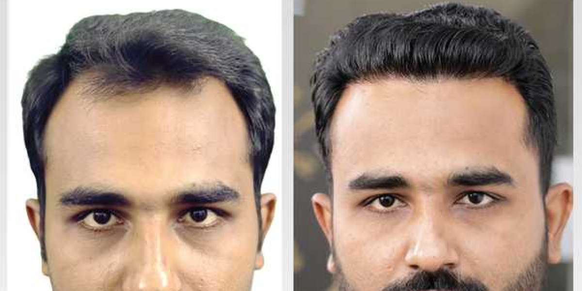 The Excellence Path to Hair Restoration with Hash Clinics' Best Hair Transplant in Karachi