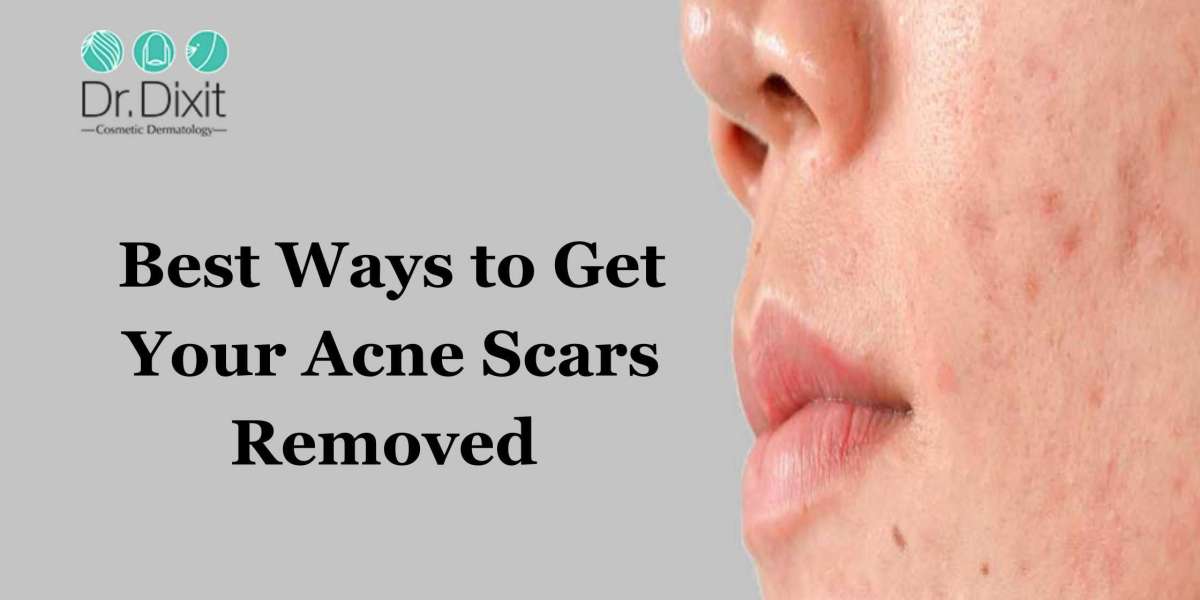 Best Ways to Get Your Acne Scars Removed