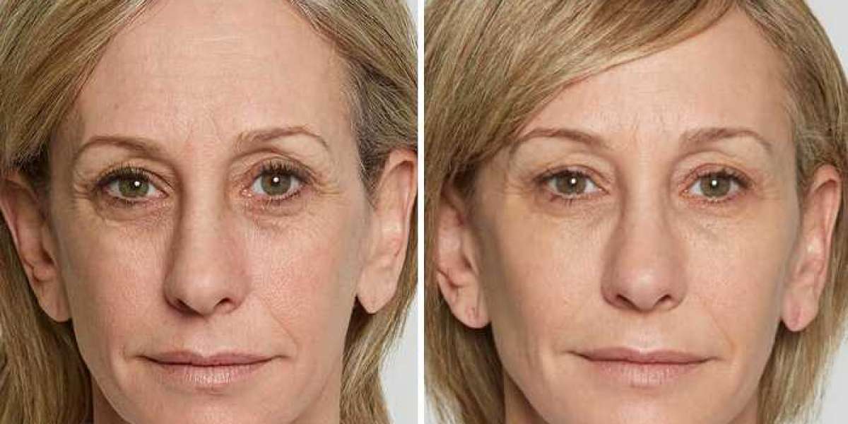 Where Can I Find Information on the Cost of Sculptra in Torrance, CA?