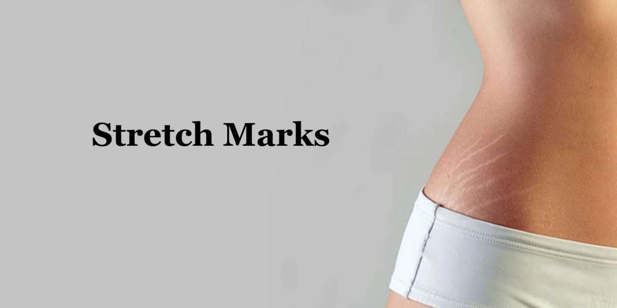 How Lasers Help Manage To Hide Stretch Marks