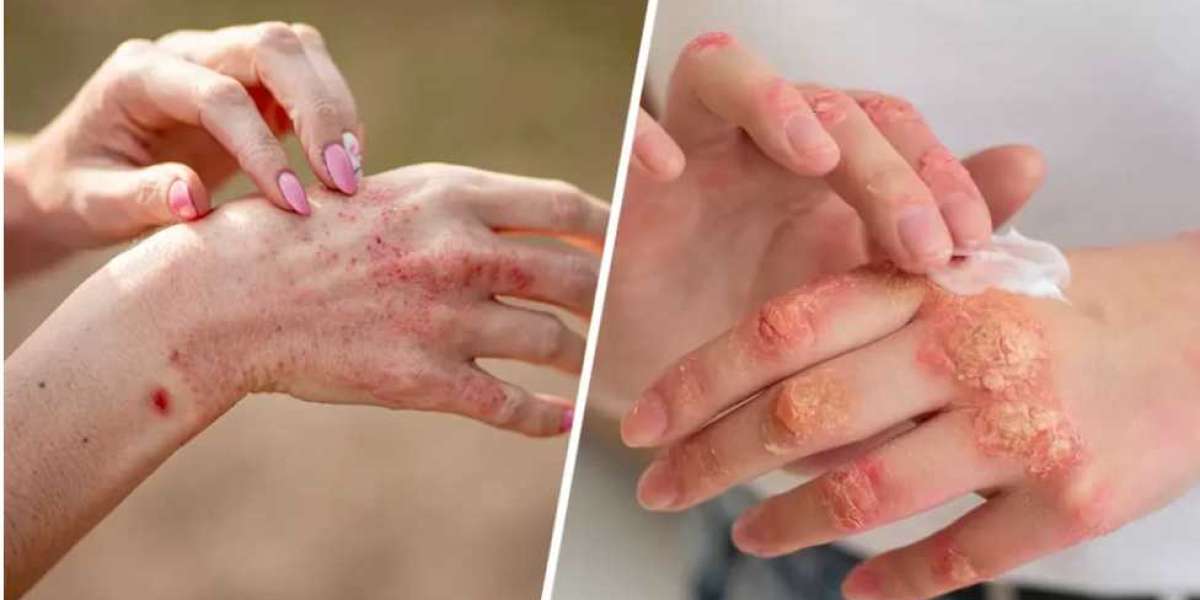 Psoriasis vs Eczema: Difference in Symptoms & Treatment