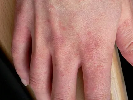 Deciphering the Keys to Successful Scabies Treatment