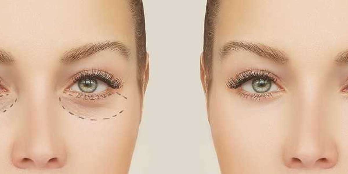 Eyelid surgery cost in Chandigarh