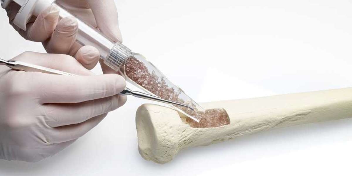 Bone Grafts Substitutes Market To Gain Substantial Traction Through 2030