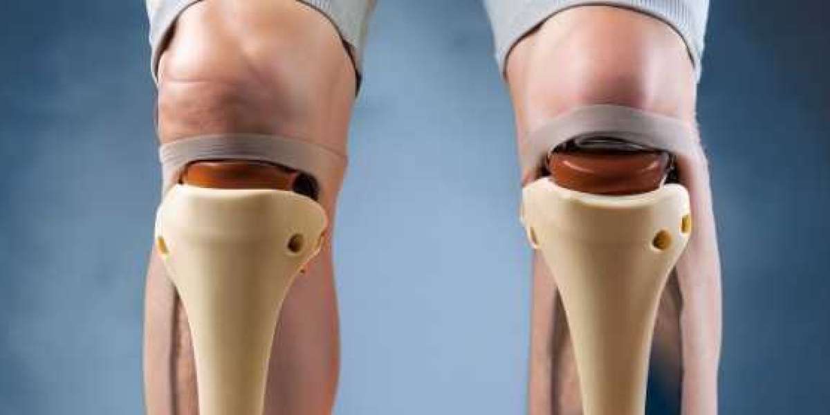 Choosing the Right Knee Replacement Surgeon: Your Guide to Pain-Free Mobility