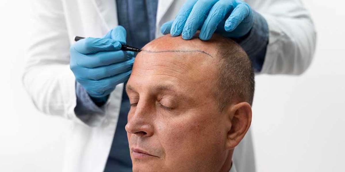 The Road to Fuller, Thicker Hair | Hair Transplant Harley Street Options