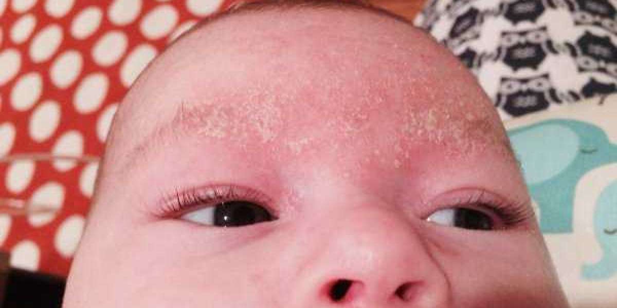 What Is Cradle Cap in Eyebrows? Symptoms and Causes Explained