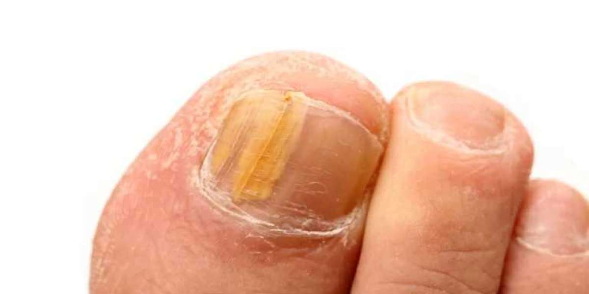 Don't Let Fungus Steal Your Shine: A Guide to Healthy Toenails with The Footwork Clinic