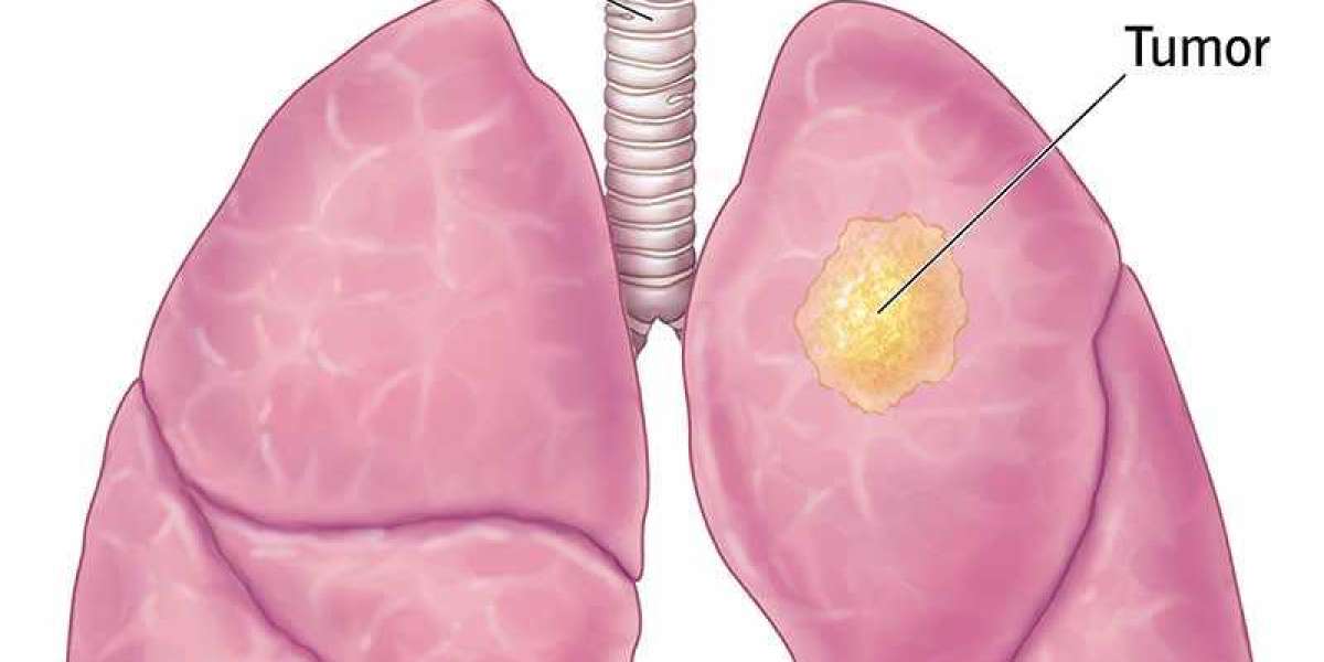 Lung Cancer Specialist in Delhi NCR