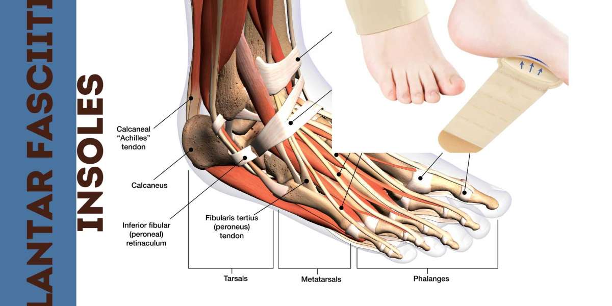 Understanding the Importance of Plantar Fasciitis Insoles and Arch Support for Plantar Health