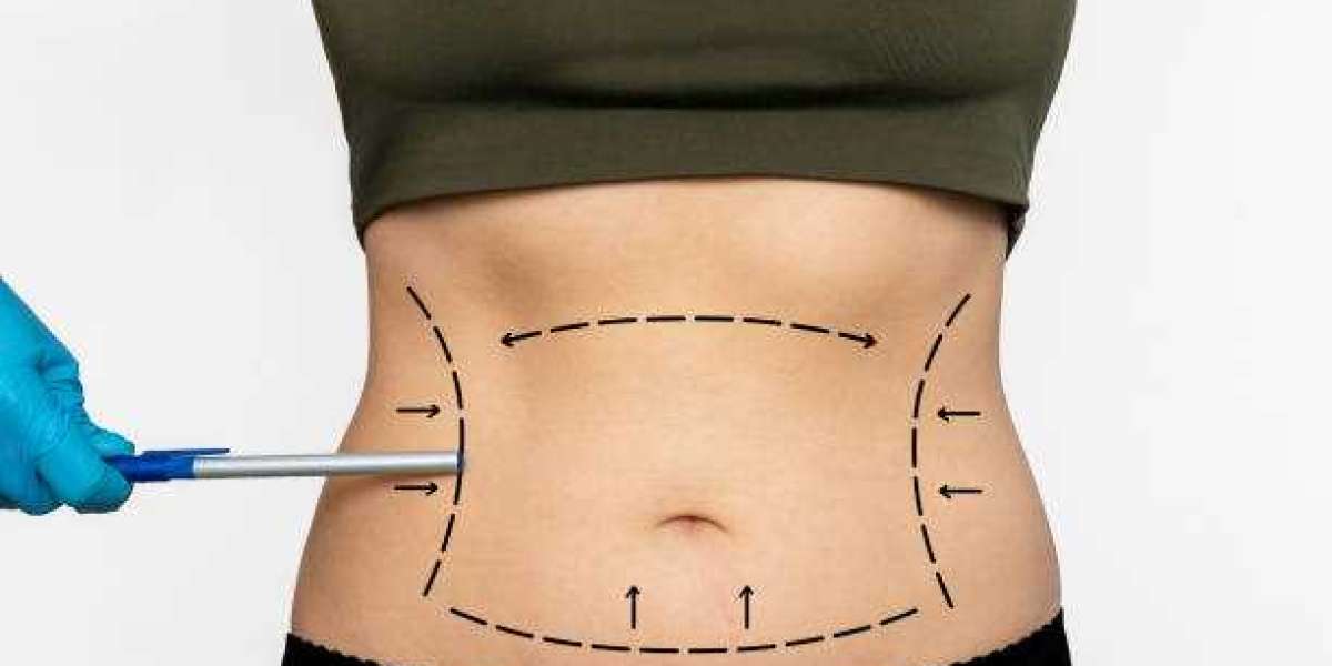The Rise of Liposuction Procedures in Dubai: Trends and Insights