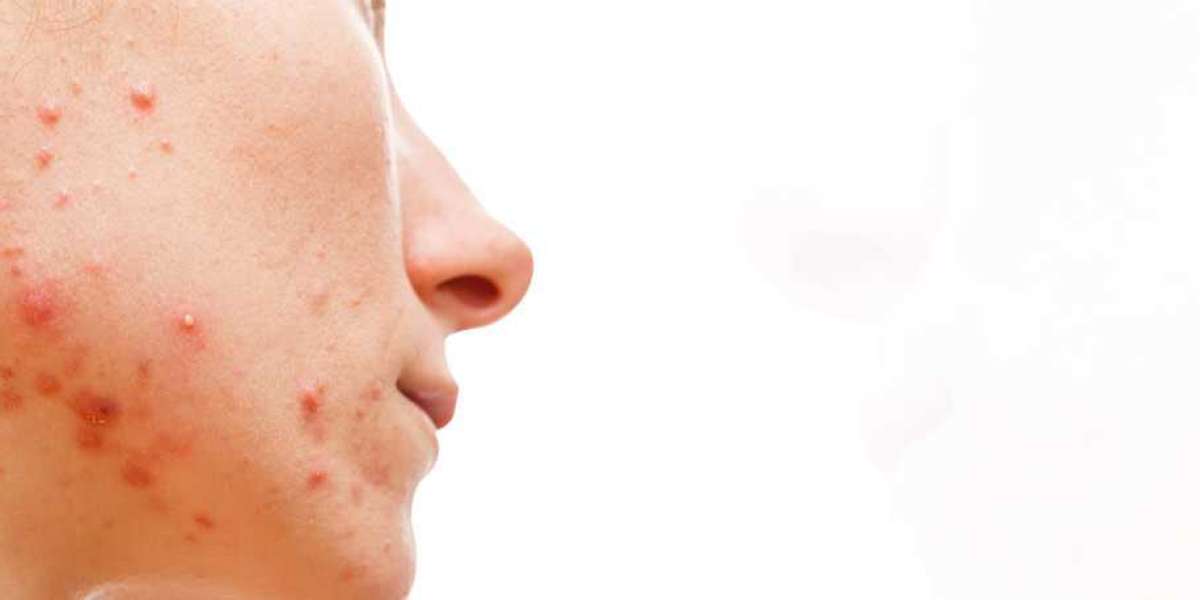 Acne: Signs, Causes, And Prevention