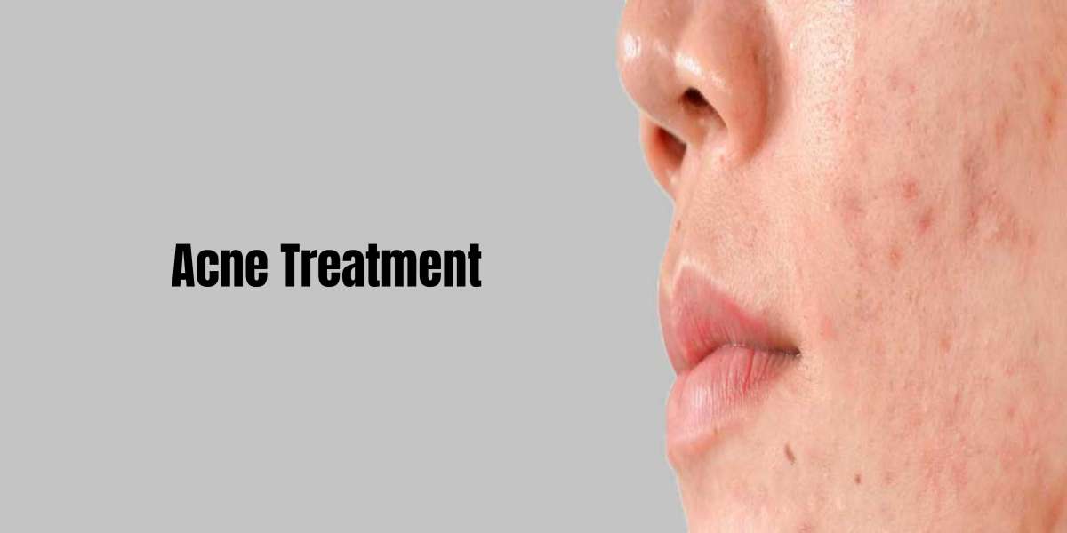 All About Best Acne Scar Removal Treatments