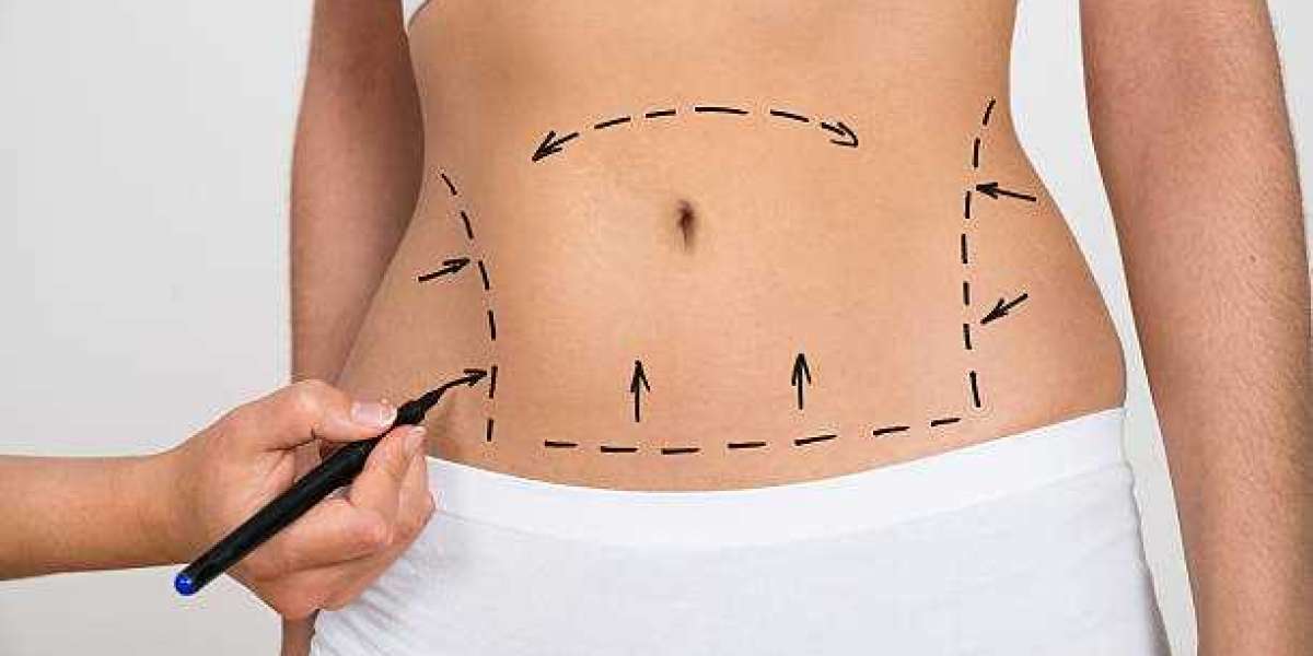 Unveil Your Inner Beauty: Abdominal Liposuction in Riyadh