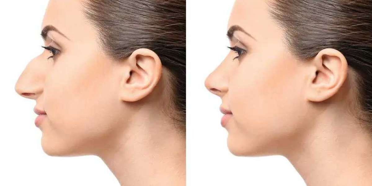 Crooked Nose Correction With Rhinoplasty