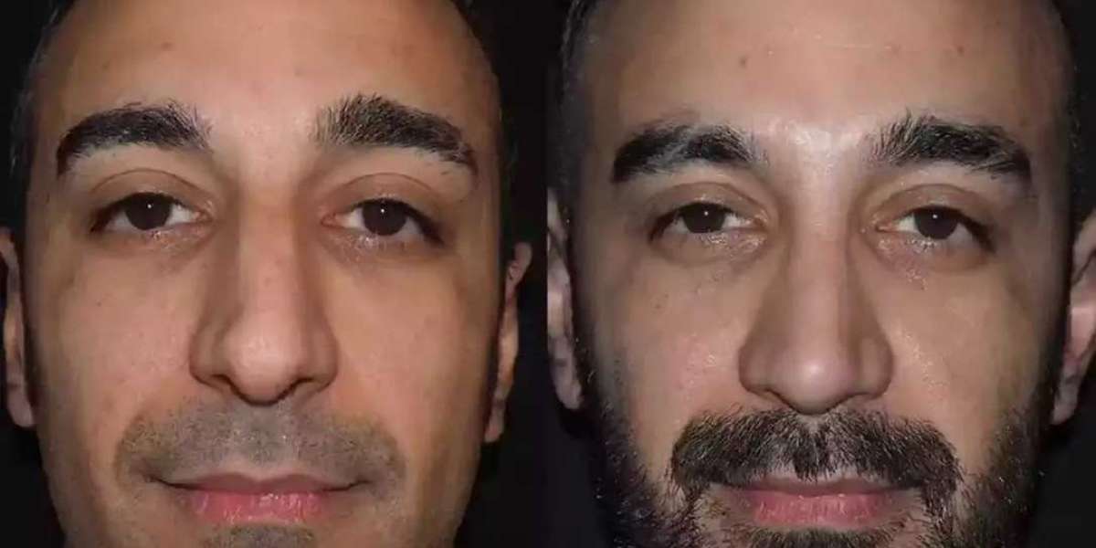 Before and After: Male Rhinoplasty Transformations