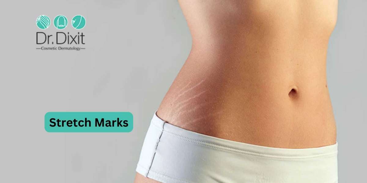 Proven Methods To Get Rid Of Stretch Marks Quickly and Safely