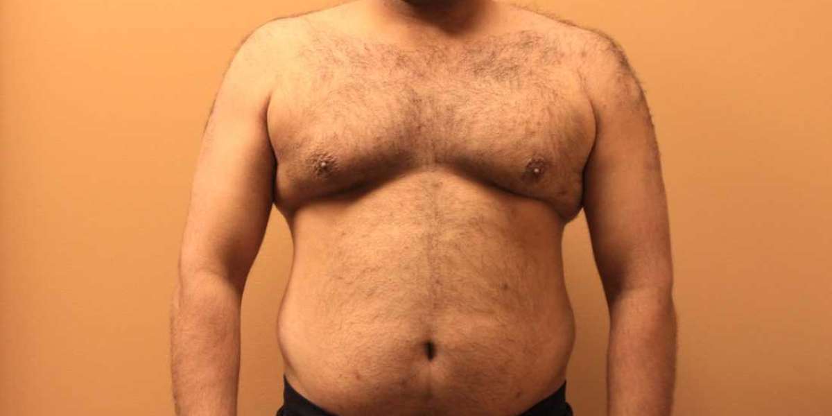 The Emotional Journey: Coping with Body Image Issues Before Gynecomastia Surgery